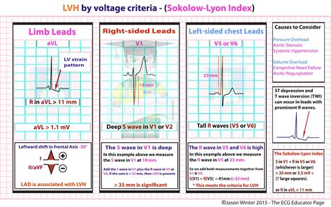 criteria for lvh on ecg.